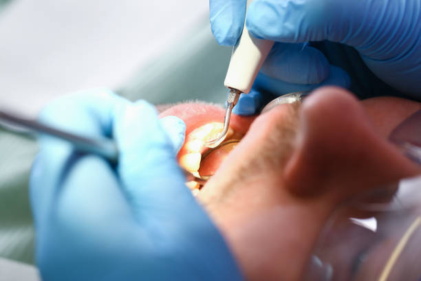 Best Emergency Dentist for Knocked-Out Tooth in Spring Hill, FL